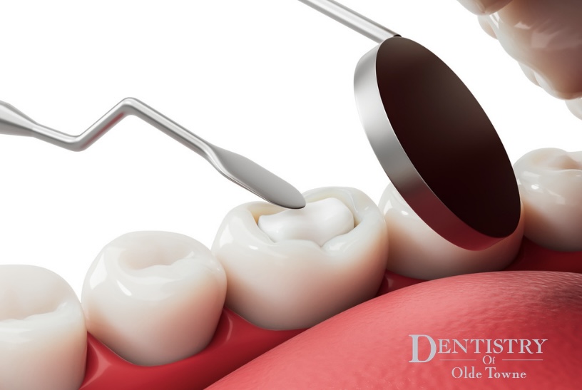 Photo showing animated tooth-colored filling