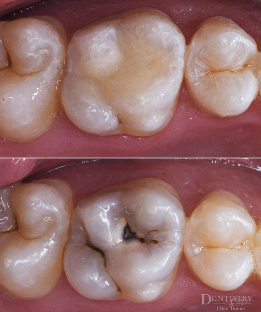 Real before and after example of composite filling