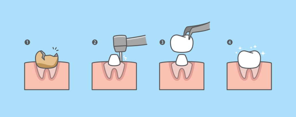 Real before and after example of composite filling